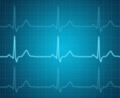 心房細動の心電図