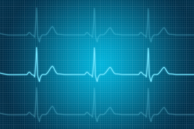 心房細動の心電図